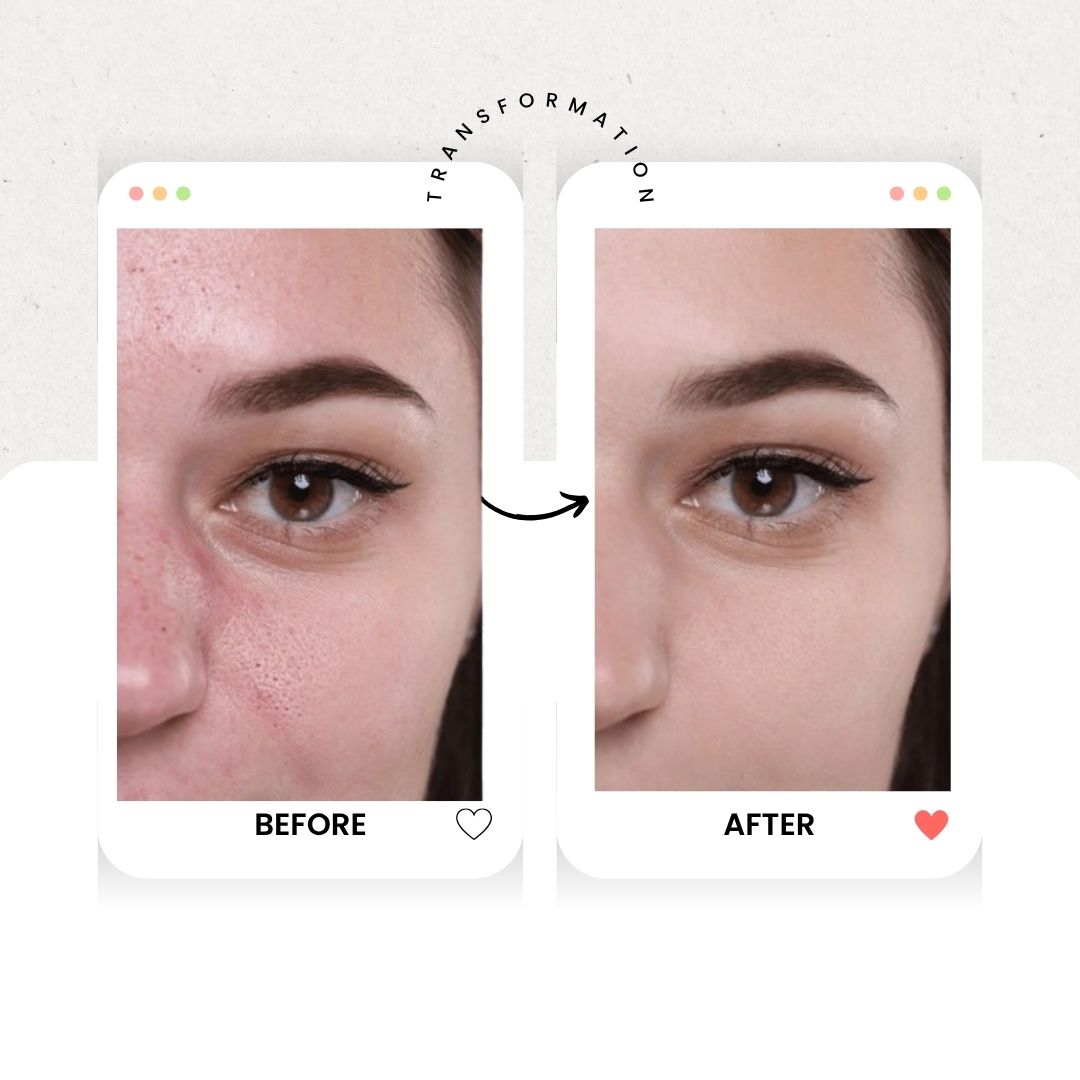 Small Bubble Blackhead Remover